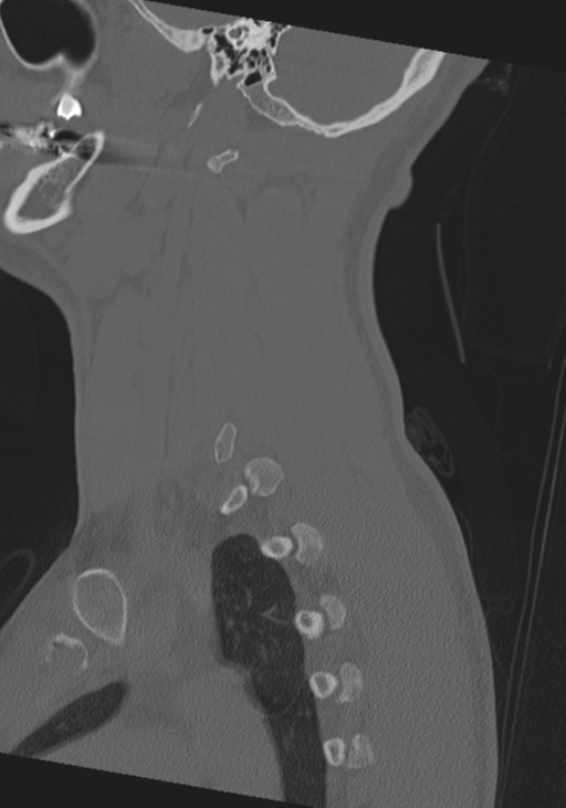 Cervical intercalary bone (Radiopaedia 35211-36748 Sagittal bone window 17).png