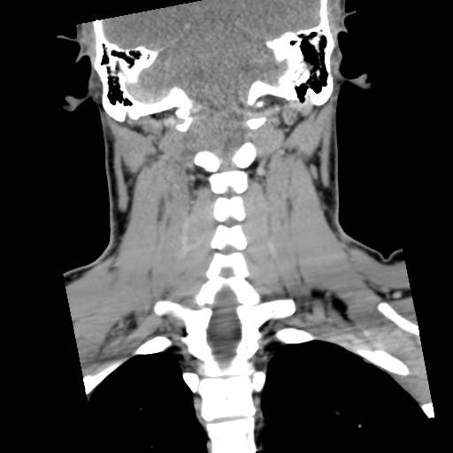 Cervical schwannoma (Radiopaedia 57979-64974 G 37).png