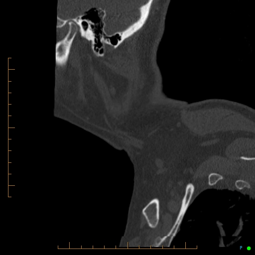 Cervical spine fracture - ankylosing spondylitis (Radiopaedia 76835-88706 Sagittal bone window 113).jpg