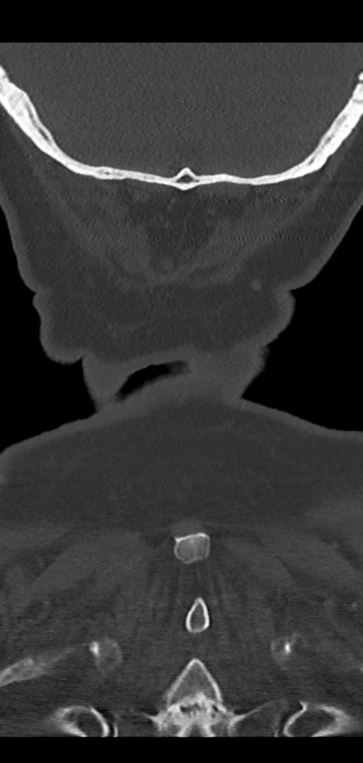 Cervical spine fracture - chalk stick (Radiopaedia 39116-41323 Coronal bone window 51).png