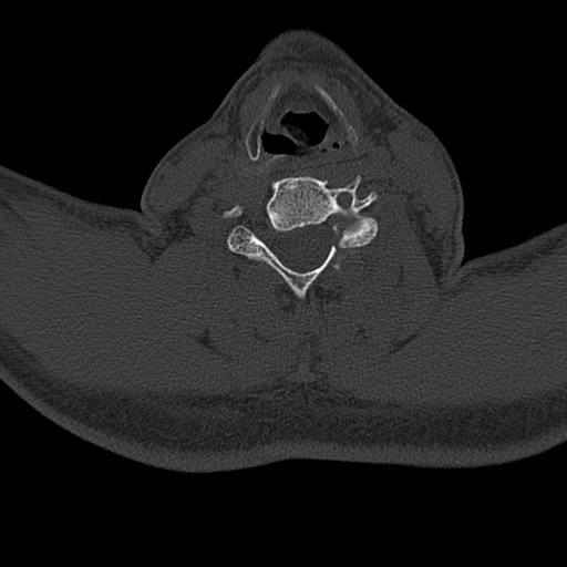Cervical spine trauma with tear drop fracture and perched facet joint (Radiopaedia 53989-60127 Axial bone window 113).jpg