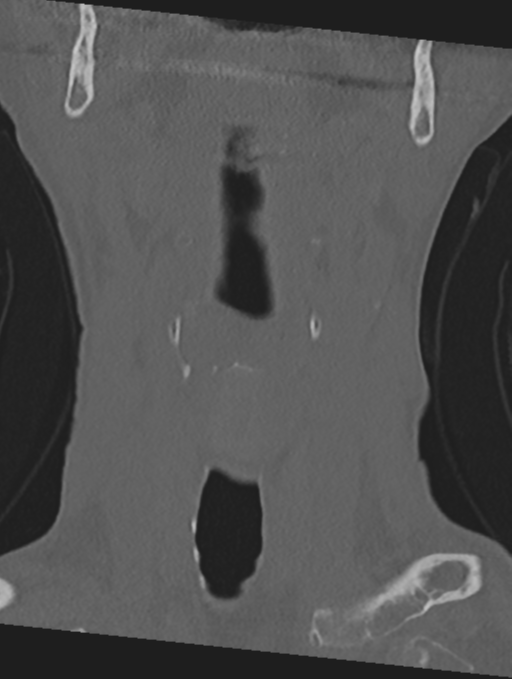 Cervical spondylolysis (Radiopaedia 49616-54811 Coronal bone window 4).png