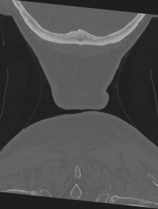 Cervical spondylolysis (Radiopaedia 49616-54811 Coronal bone window 66).png
