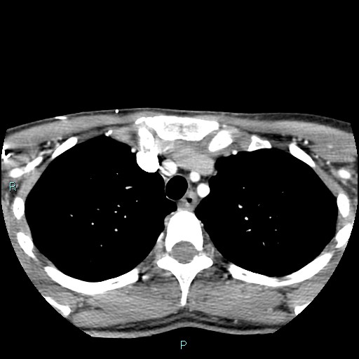 Cervical thymic cyst (Radiopaedia 88632-105335 B 11).jpg