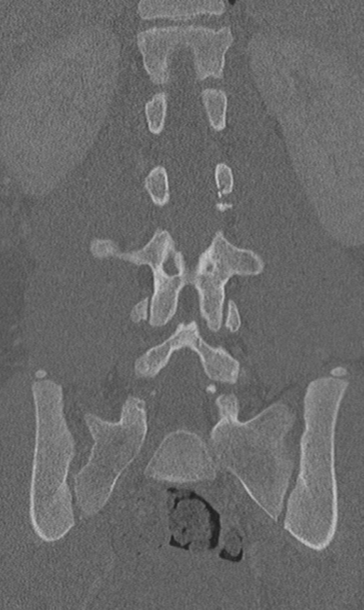 Chance fracture (Radiopaedia 40360-42912 Coronal bone window 42).png
