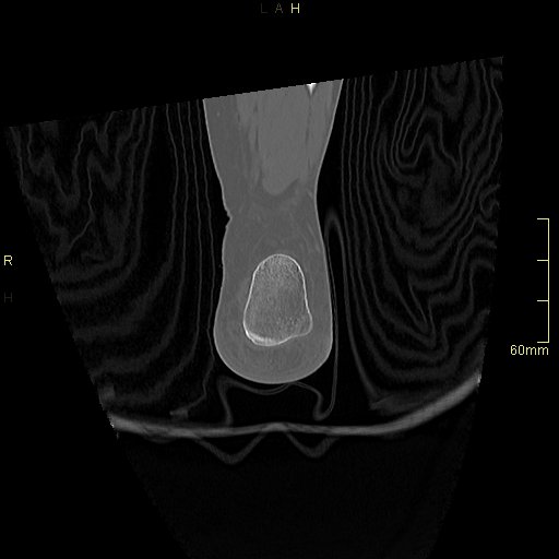 Chaput tubercle fracture (Radiopaedia 80319-93956 Coronal non-contrast 57).jpg