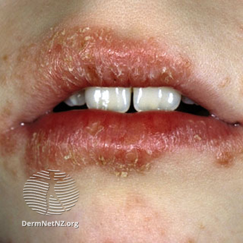 File:Cheilitis (DermNet NZ dermatitis-s-atopic24).jpg