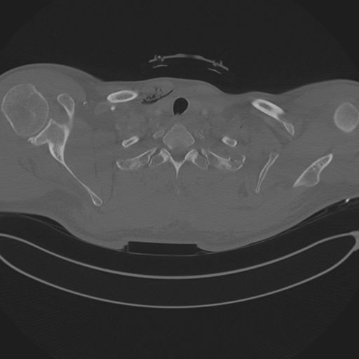 Chest multitrauma - aortic injury (Radiopaedia 34708-36147 Axial bone window 18).png