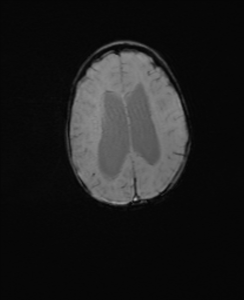 Chiari III malformation with occipital encephalocele (Radiopaedia 79446-92559 Axial SWI 45).jpg