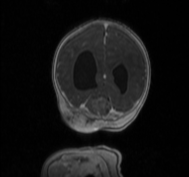 Chiari III malformation with occipital encephalocele (Radiopaedia 79446-92559 Coronal T1 C+ mpr 37).jpg