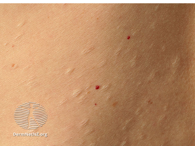 File:Chickenpox scars (DermNet NZ dermal-infiltrative-s-anetoderma02).jpg