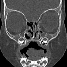 Choanal atresia (Radiopaedia 88525-105975 Coronal bone window 27).jpg