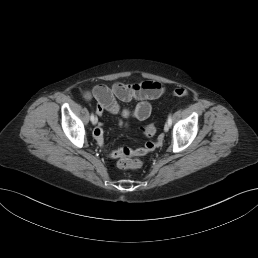 Cholecystoduodenal fistula due to calculous cholecystitis with gallstone migration (Radiopaedia 86875-103077 D 69).jpg