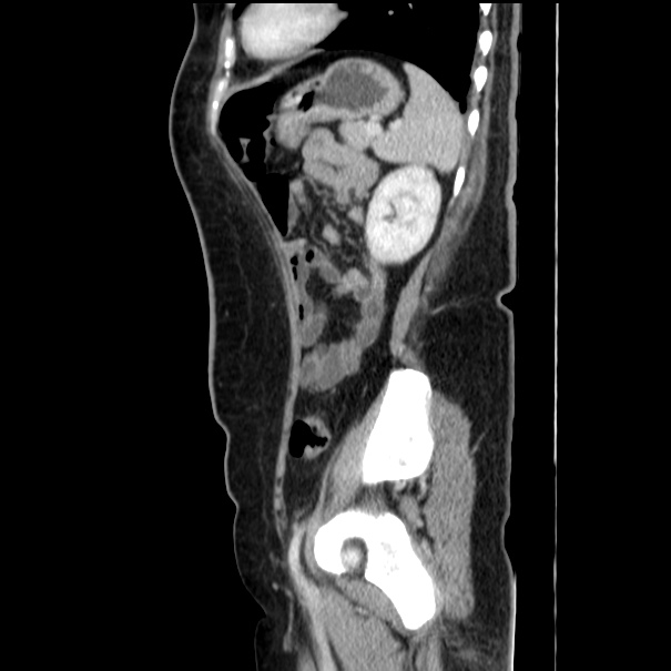 Choledocholithiasis on CT and MRI (Radiopaedia 24825-25087 D 47).jpg