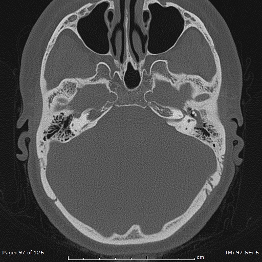 Cholesteatoma - external auditory canal (Radiopaedia 88452-105096 Axial bone window 60).jpg