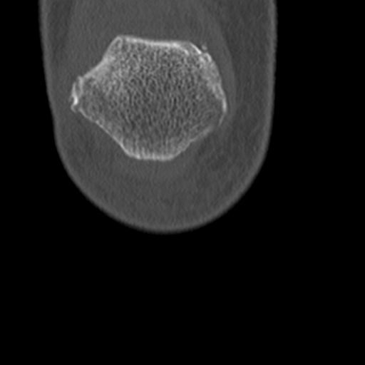 Chondrocalcinosis (Radiopaedia 16275-15955 Coronal bone window 7).jpg