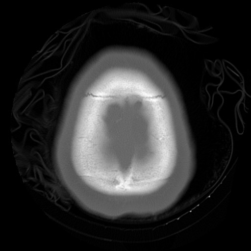 File:Chondrosarcoma - sphenoid wing (Radiopaedia 58259-67828 Axial bone window 27).jpg
