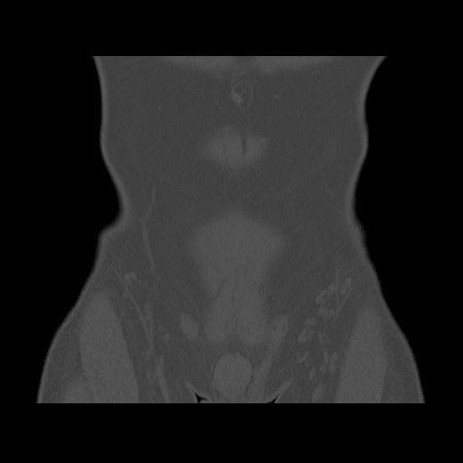 Chondrosarcoma of iliac wing (Radiopaedia 63861-72599 Coronal bone window 22).jpg