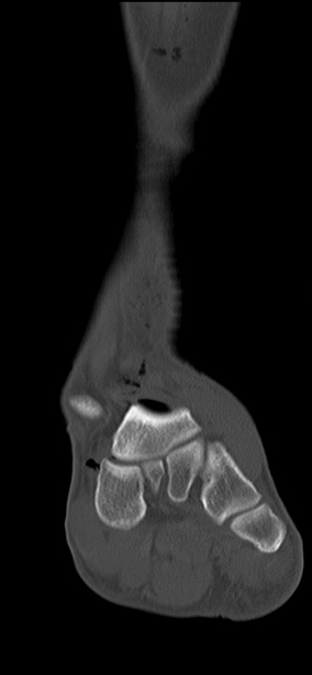 Chopart fracture (Radiopaedia 35347-36851 Coronal bone window 47).jpg