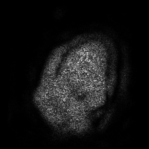 Chordoid glioma of third ventricle (Radiopaedia 91612-109340 F 1).jpg
