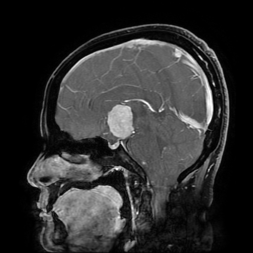 File:Chordoid glioma of third ventricle (Radiopaedia 91612-109340 F 105).jpg