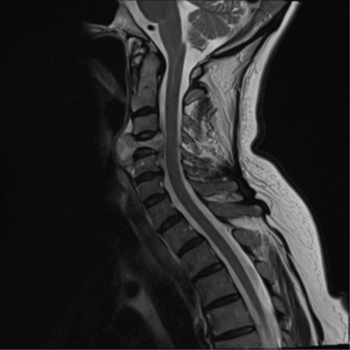 File:Chordoma (C4 vertebra) (Radiopaedia 47561-52189 Sagittal T2 7).png