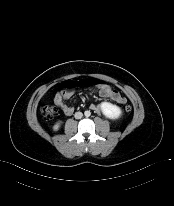 Chromophobe renal cell carcinoma (Radiopaedia 84255-99542 F 43).jpg