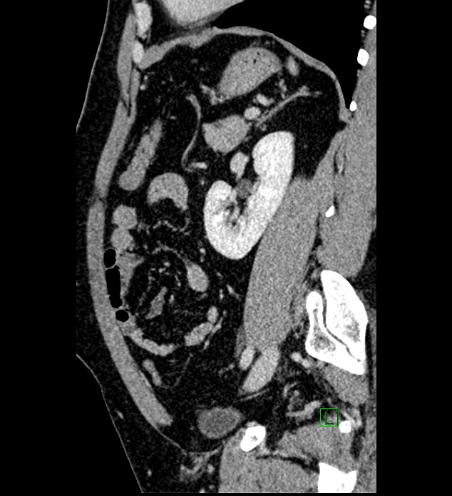 Chromophobe renal cell carcinoma (Radiopaedia 84286-99573 I 59).jpg