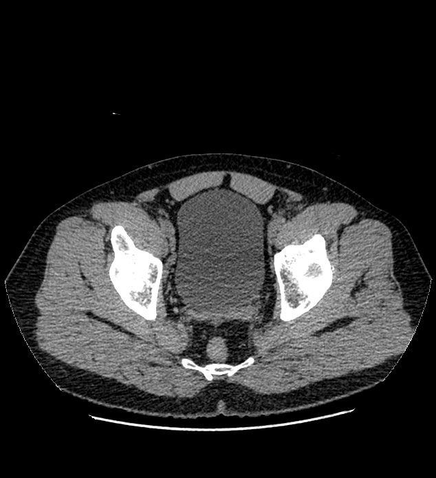 Chromophobe renal cell carcinoma (Radiopaedia 84337-99693 Axial non-contrast 145).jpg