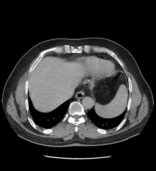 Chromophobe renal cell carcinoma (Radiopaedia 86879-103083 D 11).jpg