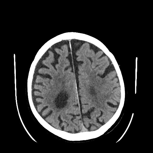 Chronic bilateral subdural hygroma (Radiopaedia 85801-101622 Axial non-contrast 52).jpg
