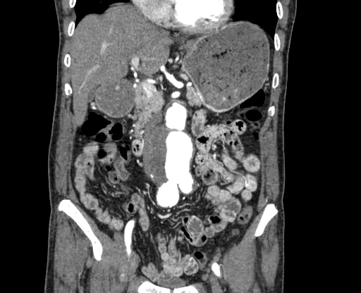 Chronic contained rupture of abdominal aortic aneurysm with extensive erosion of the vertebral bodies (Radiopaedia 55450-61901 D 23).jpg