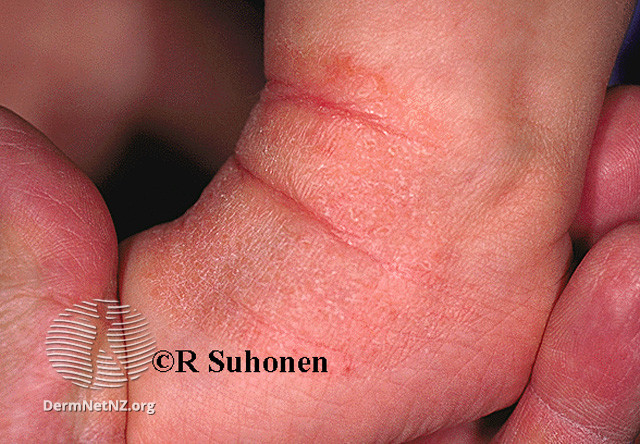 File:Chronic eczema (DermNet NZ dermatitis-s-atopic9).jpg