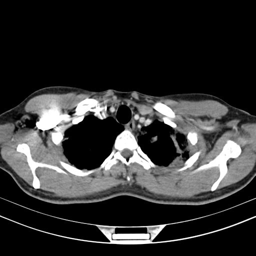 Chronic eosinophilic pneumonia (Radiopaedia 39331-41587 Axial C+ delayed 25).png