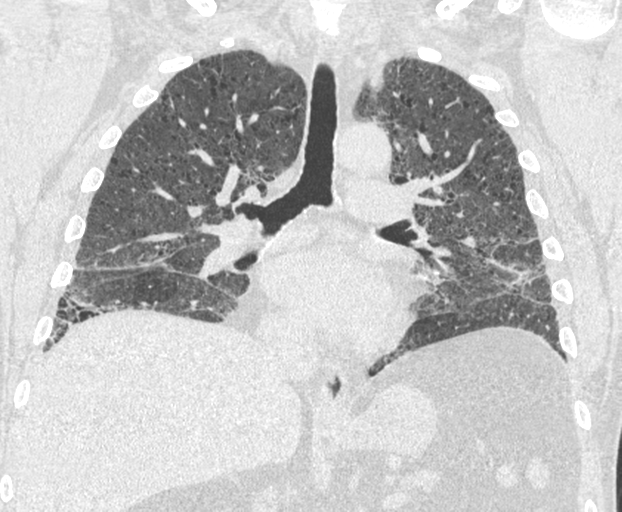 File:Chronic hypersensitivity pneumonitis (Radiopaedia 48107-52922 Coronal lung window 15).png