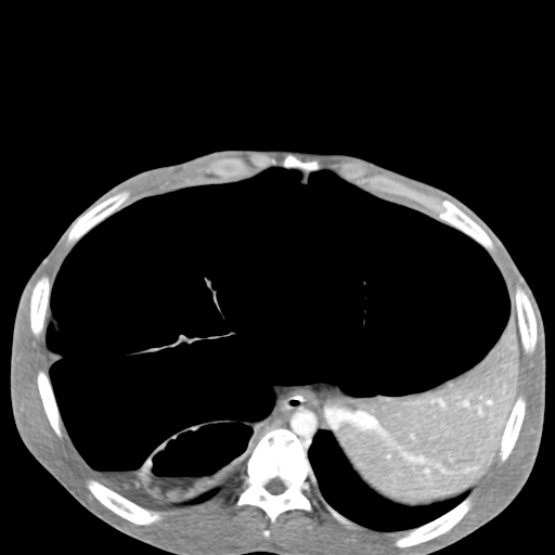 Chronic large bowel pseudo-obstruction (Radiopaedia 43181-46492 A 43).jpg