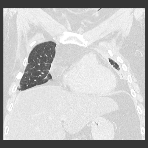 File:Chronic lung allograft dysfunction - restrictive form (Radiopaedia 60595-68316 Coronal lung window 37).jpg