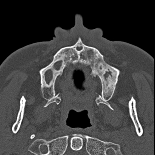 Chronic maxillary sinusitis (Radiopaedia 27879-28116 Axial bone window 5).jpg