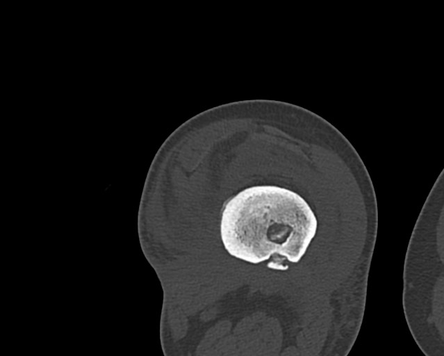 Chronic ostemyelitis of the femur with long sinus tract (Radiopaedia 74947-85982 Axial bone window 168).jpg
