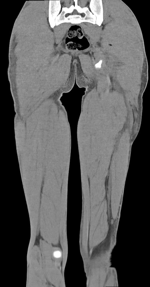 Chronic osteomyelitis (with sequestrum) (Radiopaedia 74813-85822 E 45).jpg