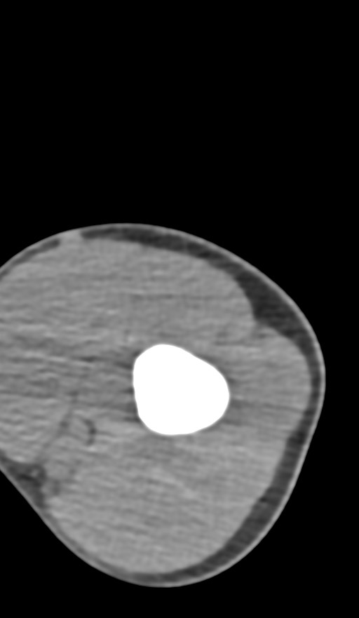 Chronic osteomyelitis of the distal humerus (Radiopaedia 78351-90971 Axial non-contrast 47).jpg