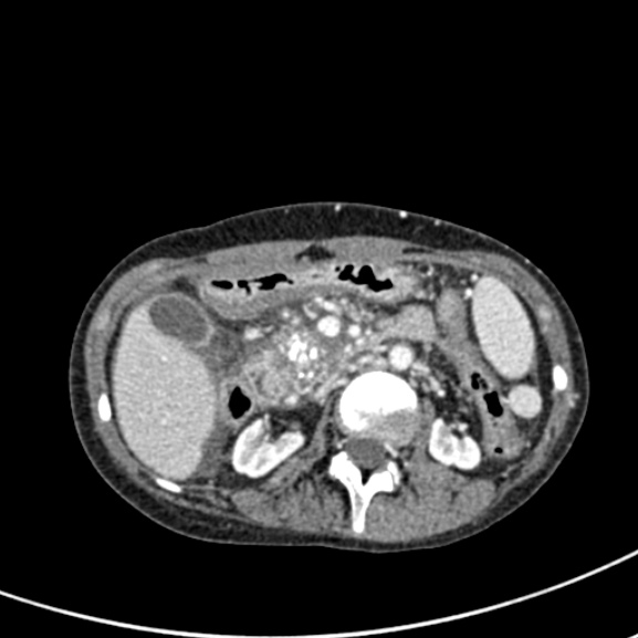 File:Chronic pancreatitis (Radiopaedia 55405-61846 A 42).jpg