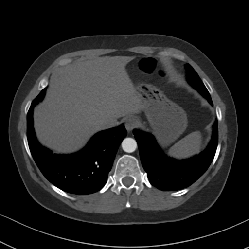 Chronic pulmonary embolus (Radiopaedia 39129-41341 Axial C+ CTPA 85).png