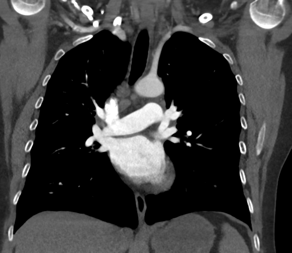 File:Chronic pulmonary embolus (Radiopaedia 39129-41341 Coronal C+ CTPA 45).png