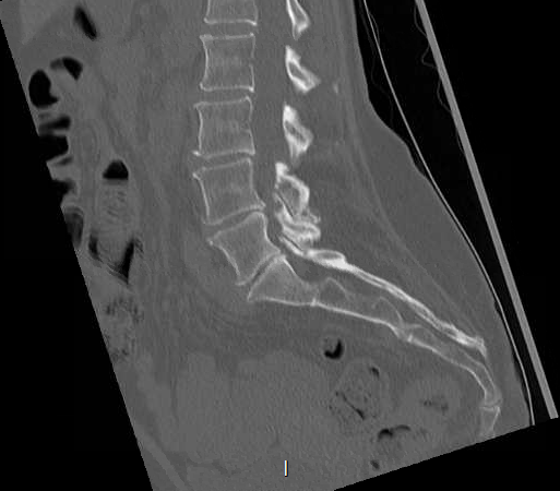 File:Chronic spinal hematoma with cauda equina syndrome (Radiopaedia 75745-88197 Sagittal bone window 17).png