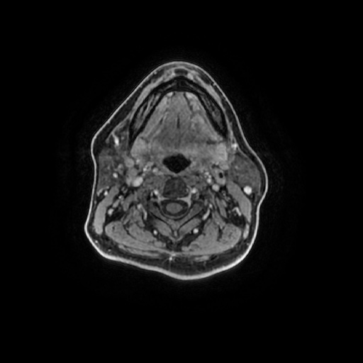 Chronic submandibular sialadenitis (Radiopaedia 61852-69885 Axial T1 C+ fat sat 61).jpg