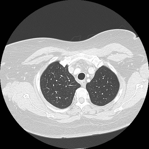 Cicatrisation collapse (Radiopaedia 17405-17089 lung window 21).jpg