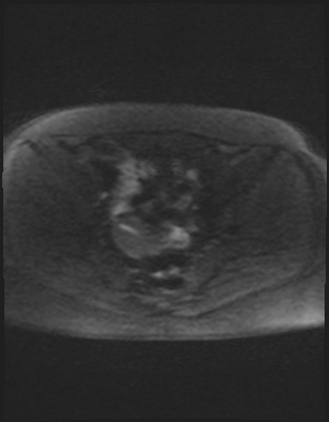 Class II Mullerian duct anomaly- unicornuate uterus with rudimentary horn and non-communicating cavity (Radiopaedia 39441-41755 Axial DWI 46).jpg