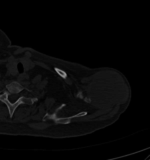 Clear cell chondrosarcoma - humerus (Radiopaedia 63104-71612 Axial bone window 20).jpg
