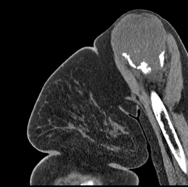 Clear cell chondrosarcoma - humerus (Radiopaedia 63104-71612 D 17).jpg